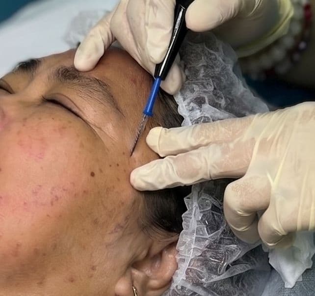 Warts Removal